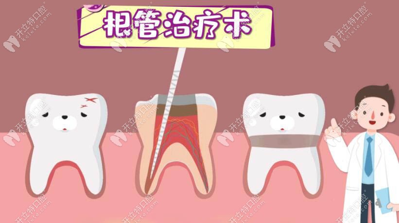 这就是牙齿根管治疗术