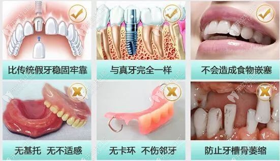 陈祥宙医生做种植牙的优势