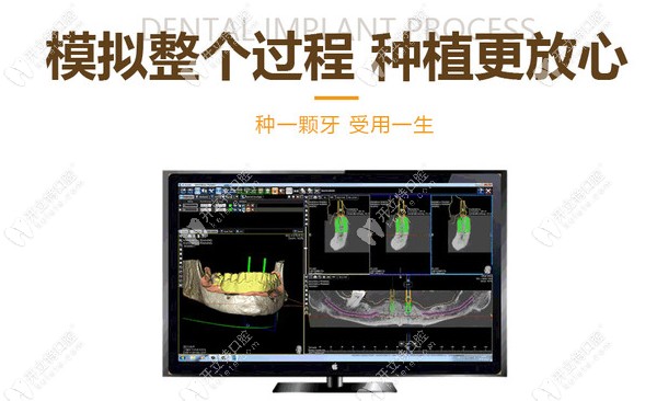 数字化导板种植牙技术