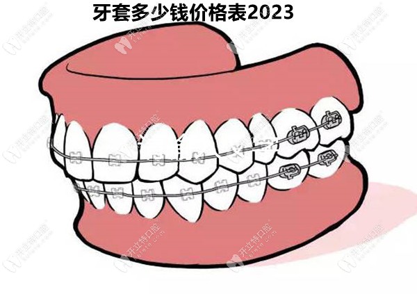 牙套多少钱价格表2023:含金属钢牙/陶瓷/隐形牙套矫正多少钱