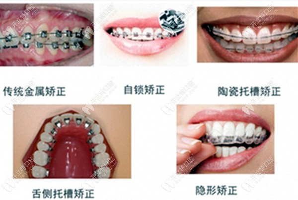各类牙齿矫正器的图www.kelete.com