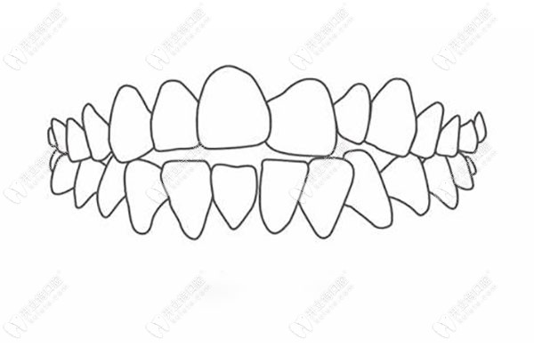 牙齿开颌影响脸型吗