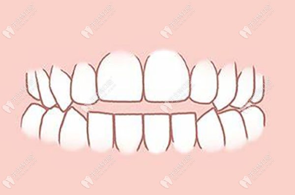 牙齿开颌有什么危害