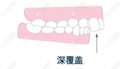 深覆盖