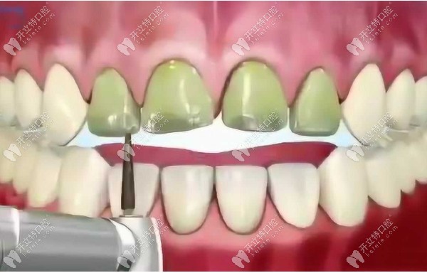 牙齿贴面修复前备牙图
