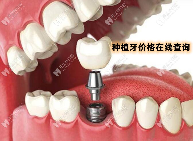北京泰康拜博口腔种植牙价格表,种牙3980元起一颗,收费不高