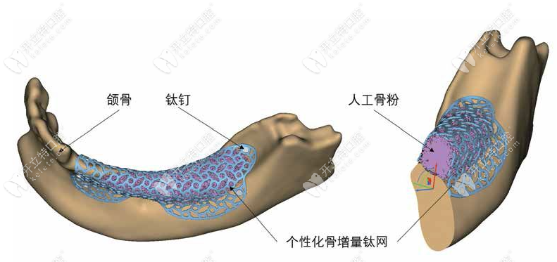 PAOO骨增量手术