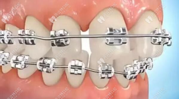 矫正牙齿加快速度会怎么样?会导致牙周损伤,牙根吸收等风险
