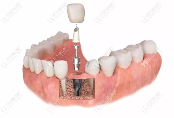 单颗种植牙的图www.kelete.com