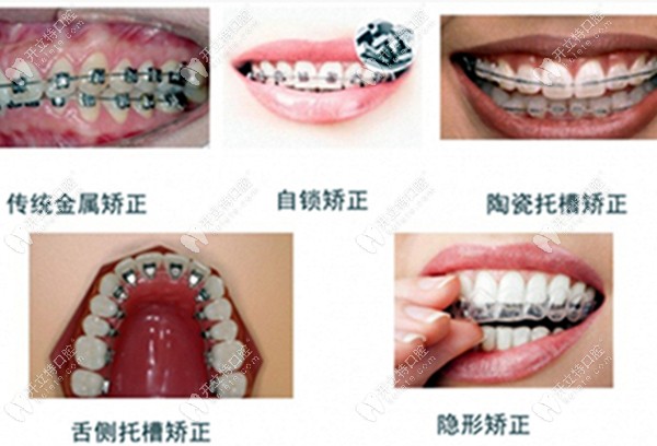 牙齿矫正器的类型www.kelete.com