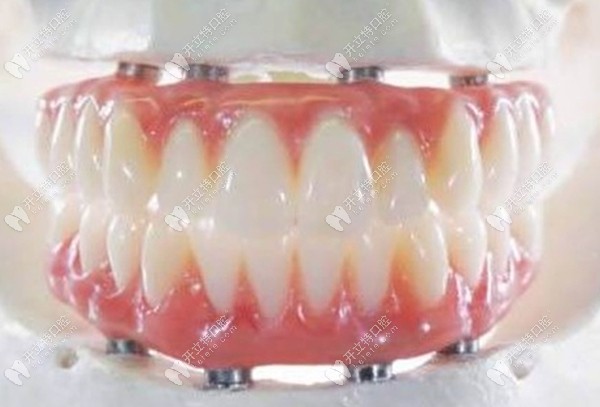全口种植牙的图www.kelete.com