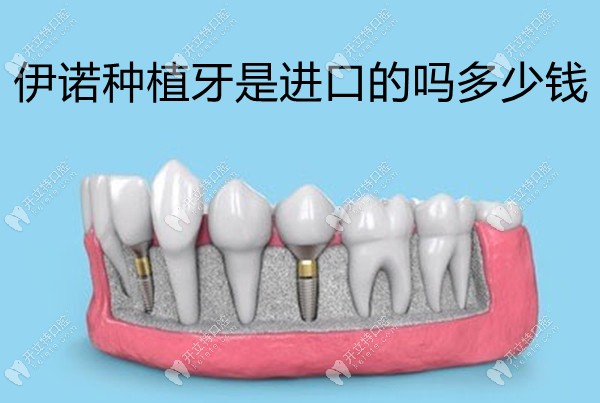 伊诺种植牙是进口的吗多少钱,inno是韩国进口种植牙价位中等