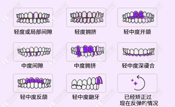 林艺娟医生可改善的牙齿畸形类型