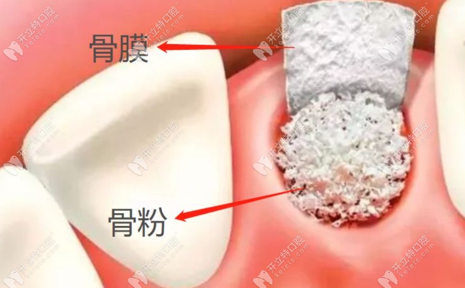 种植牙骨粉和骨膜
