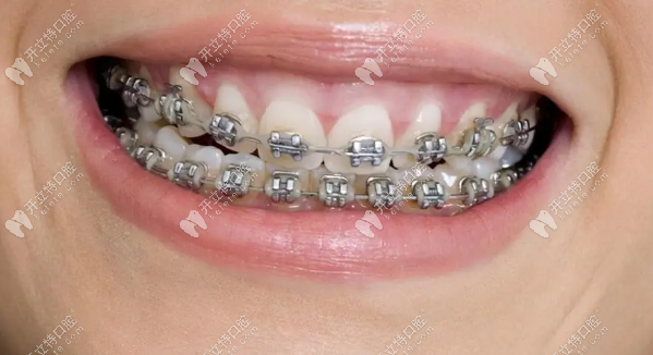 钢牙套多少钱价格表2023(金属矫正牙齿国产5000、进口9800元起)