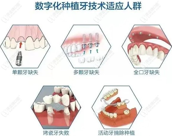 合肥美奥口腔种植牙齿技术怎么样m.kelete.com