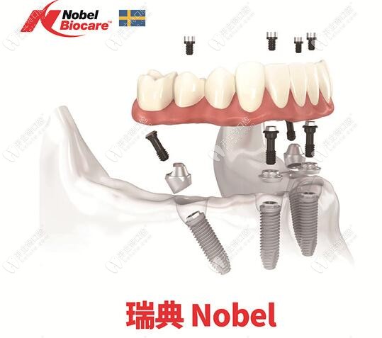 瑞典诺贝尔pmc种植牙集采后价格