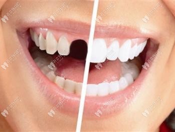 牙齿缺失的危害有哪些