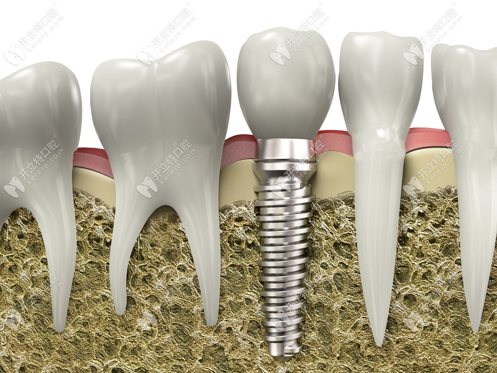 珠海种植牙集采价格表www.kelete.com