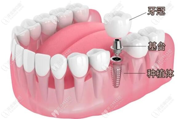 种植牙也是镶牙修复的一种方式