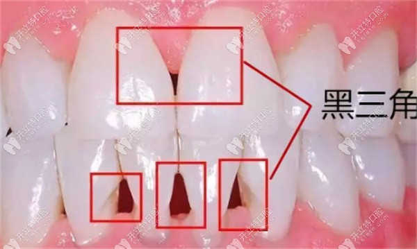 什么是牙齿黑三角?解答牙龈萎缩牙齿黑三角的原因和危害