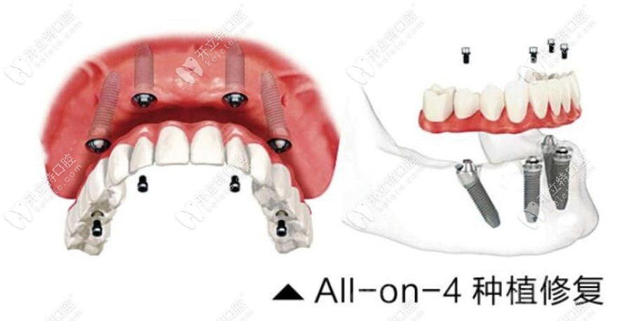 全口Allon4种植牙技术