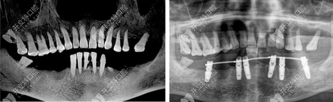徐州牙知道口腔下半口即刻种植牙病例