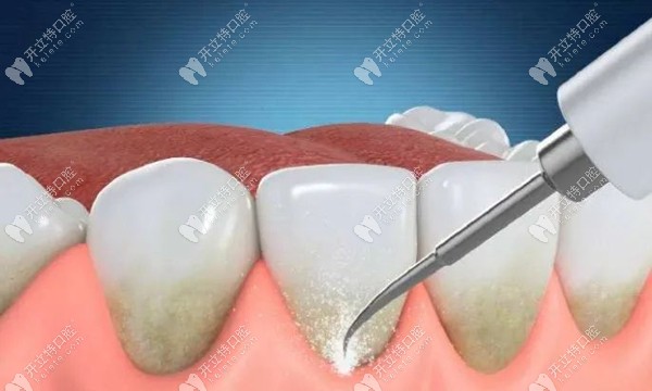 磁伸式洗牙和超声波洗牙的区别