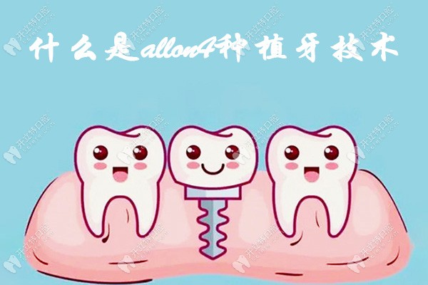什么是allon4种植牙技术