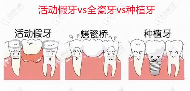 老百姓可做活动义齿、全瓷牙、种植牙