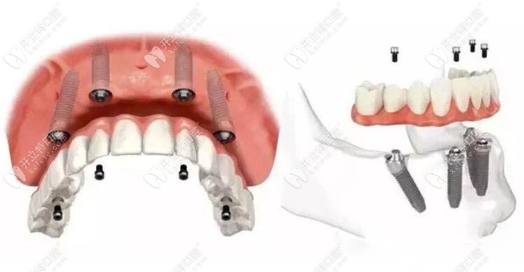 ALL-ON-4種植牙技術(shù)