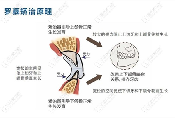 儿童罗慕早期干预矫正的原理