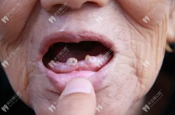 牙齿缺失www.kelete.com