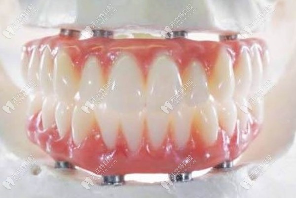 全口种植牙的图www.kelete.com