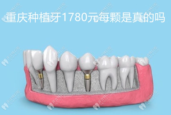 重庆种植牙1780元每颗是真的吗,是,重庆市场价1780/2680/2w+都有