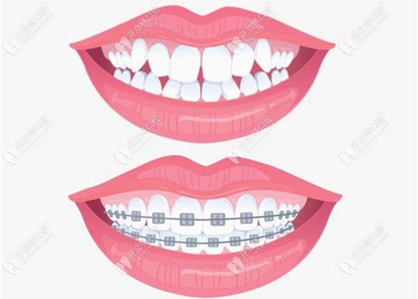牙齿矫正器和保持器的区别介绍