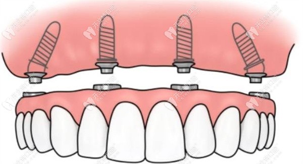 all-on-4半口种植牙价格表kelete.com