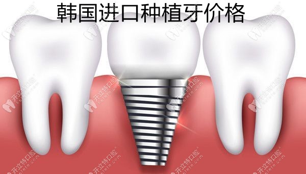 韩国进口种植牙的价格kelete.com