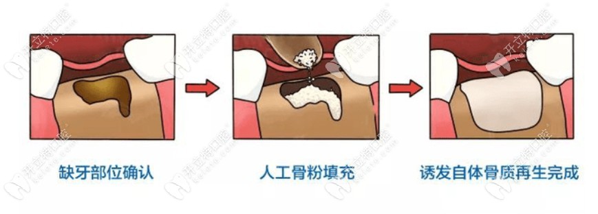 种植牙植骨的流程图