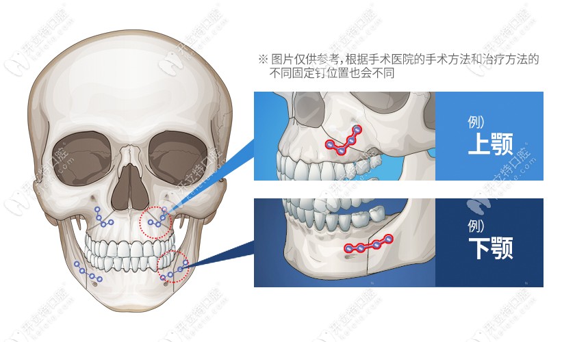 正颌手术后可能出现咬合异常问题