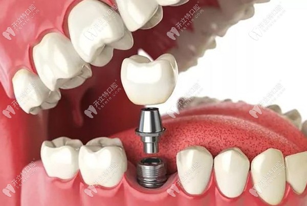 种植牙植入过程