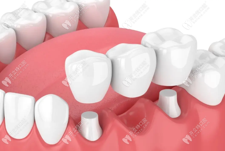 牙冠是口腔项目之一