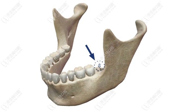 磨牙缺失可不可以用智齿正畸替代?能!缺大牙不一定要种植