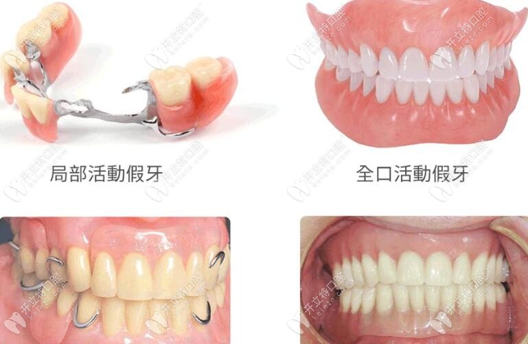 活动假牙修复方法kelete.com