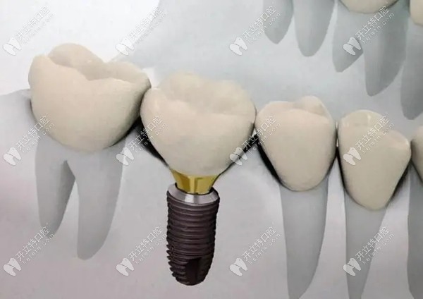 三四線國(guó)產(chǎn)種植牙價(jià)格表