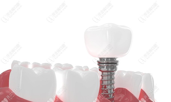 2023年美國(guó)進(jìn)口種植牙價(jià)格