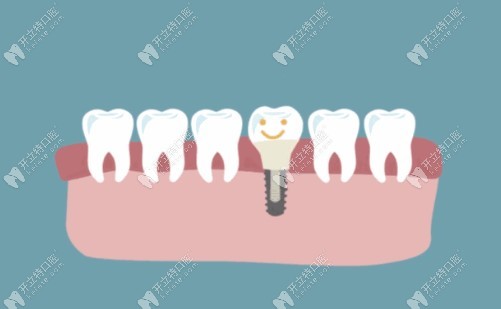 种植牙过程痛吗www.kelete.com