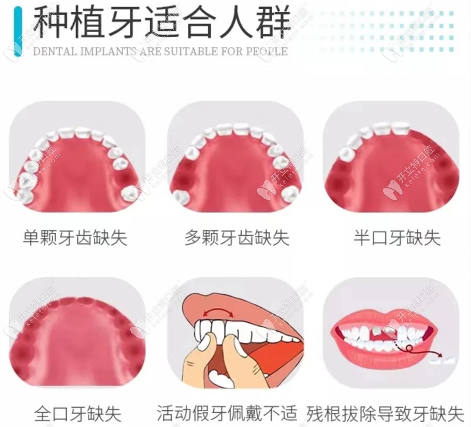 种牙齿的全部过程