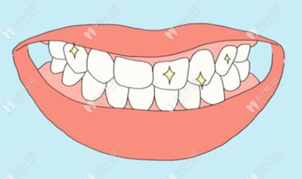 全口牙齿修复