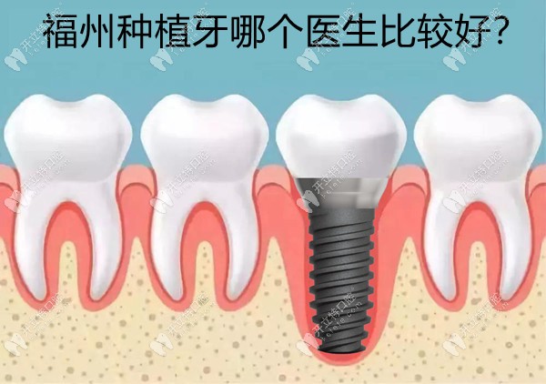 福州种植牙哪个医生比较好？